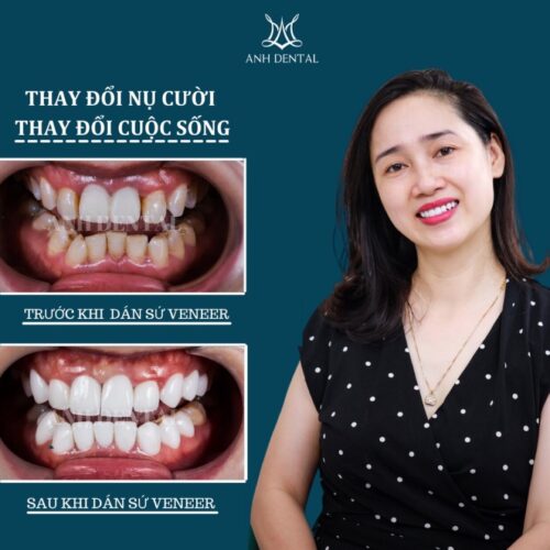 dán sứ veneer